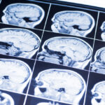 Abogados De Lesiones Cerebrales en Los Ángeles