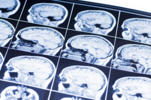 Abogados De Lesiones Cerebrales en Los Ángeles
