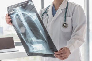 What Kinds Of Accidents Can Cause Herniated Discs At C4/C5 Or C5/C6? 
